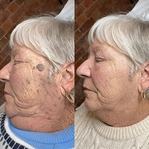 Advanced Skin Tag & Wart Remover Roll-On