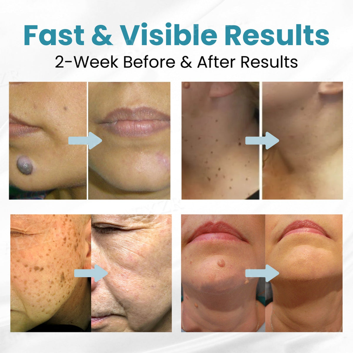 Bloomelle ClearSkin™ Precision Skin Pen
